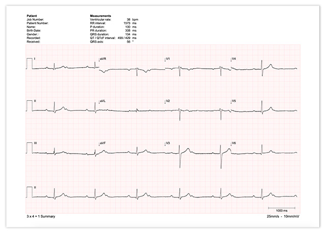 Ecg Report 4x3p1