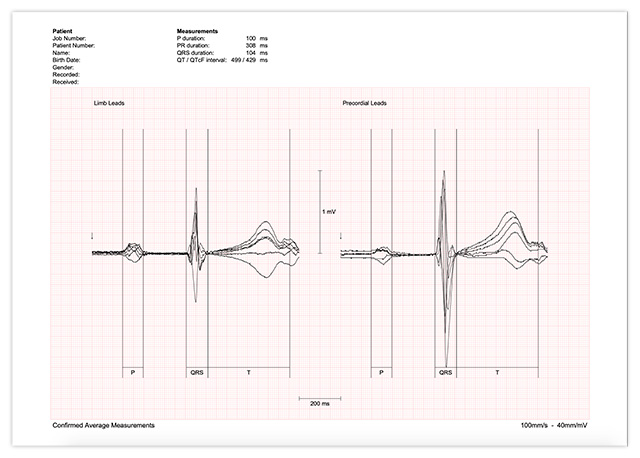 Ecg Report Avg