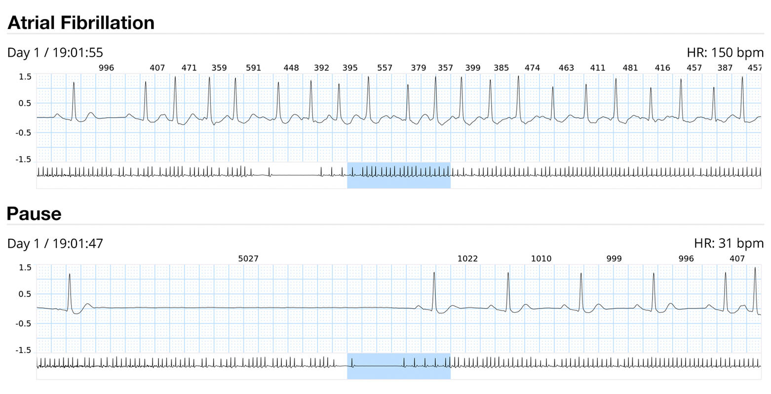 24-hour ECG Holter Monitoring Service - ECG on Demand