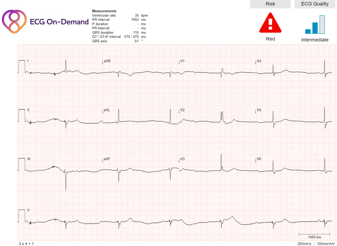 CHB, profound bradycardia, LAFB and IRBBB - Ambulatory ECG Holter ...