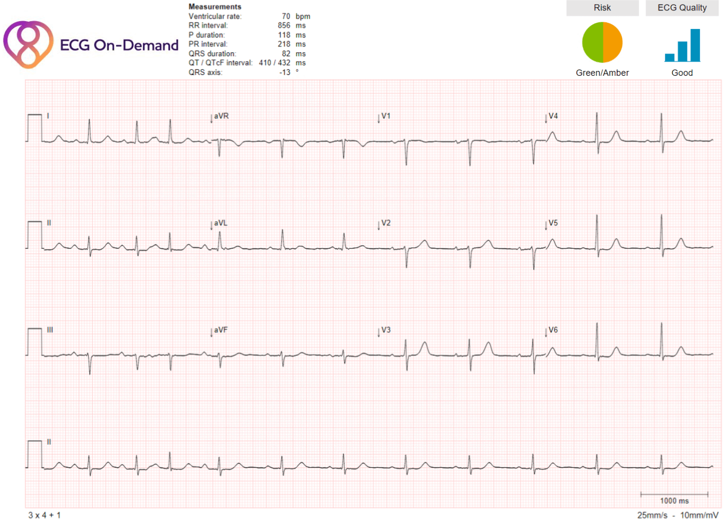 First Degree AV Block 1 PAC Sinus Arrhythmia Ambulatory ECG Holter 