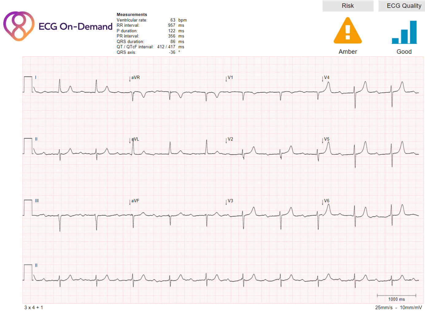 Marked first degree AV block 356ms, P-wave duration 122ms, poor R-wave ...