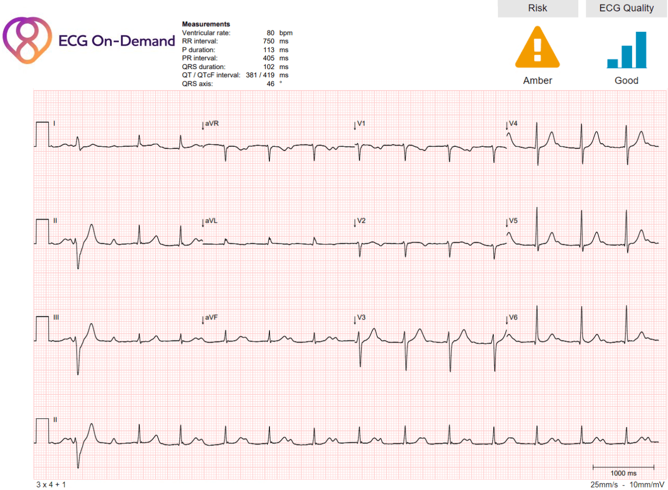 marked-first-degree-av-block-and-1-aberrantly-conducted-pac