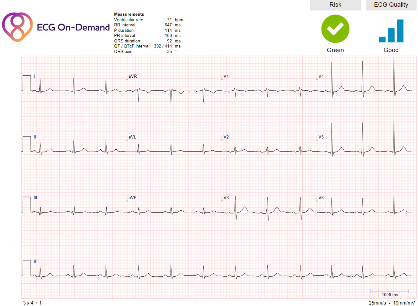 sinus-rhythm-with-incomplete-right-bundle-branch-block-ambulatory-ecg